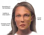 Tratamento da Paralisia Facial (9)