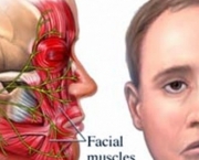 Tratamento da Paralisia Facial (12)
