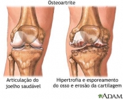 Tratamento Osteoartrite (11)