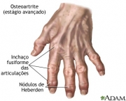 Tratamento Osteoartrite (13)