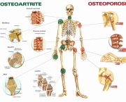 Tratamento Osteoartrite (15)