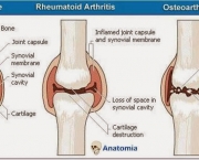 Tratamento Osteoartrite (17)