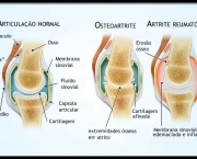 Tratamento Osteoartrite (18)