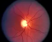 tudo-sobre-glaucoma-1