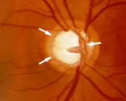 tudo-sobre-glaucoma-2