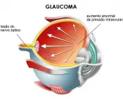 tudo-sobre-glaucoma-7