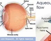 tudo-sobre-glaucoma-8