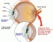 tudo-sobre-glaucoma-9
