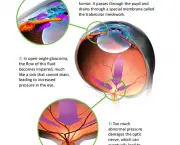 tudo-sobre-glaucoma-3
