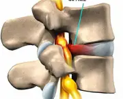 tudo-sobre-hernias-de-disco-problemas-na-coluna-vertebral-1