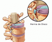 tudo-sobre-hernias-de-disco-problemas-na-coluna-vertebral-2