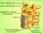 tudo-sobre-hernias-de-disco-problemas-na-coluna-vertebral-4
