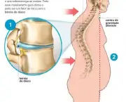 tudo-sobre-hernias-de-disco-problemas-na-coluna-vertebral-5
