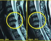 tudo-sobre-hernias-de-disco-problemas-na-coluna-vertebral-8