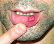 Ulceração (1)