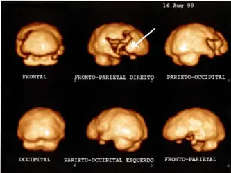 Isquemia Cerebral
