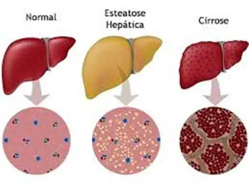 Diferença Entre o Fígado Saudável e com Doença