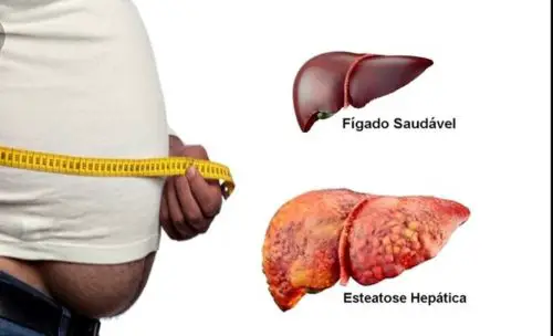 Esteatose Hepática - Fígado Saudável e Doente