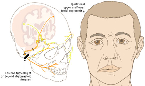 Anomalia do Nervo Facial
