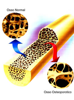 Influência da Alimentação na Osteoporose