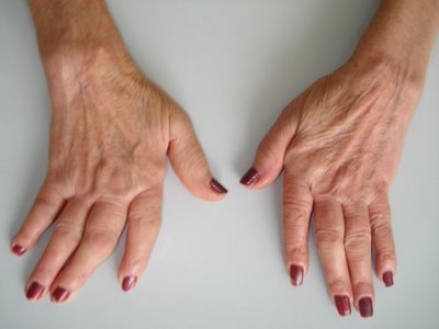 Artrose nas Mãos 