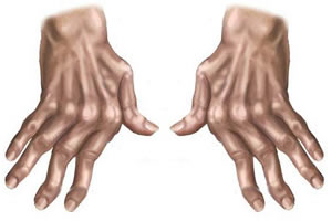 Artrose nas Mãos 