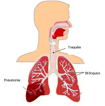 Doença Pneumonia