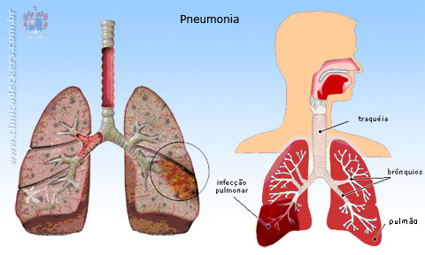 Pneumonia na Infância