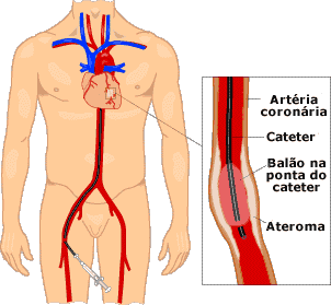 Doença Arterial Coronariana