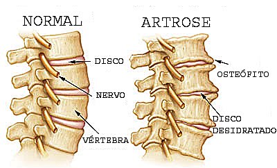 Artrose na Coluna