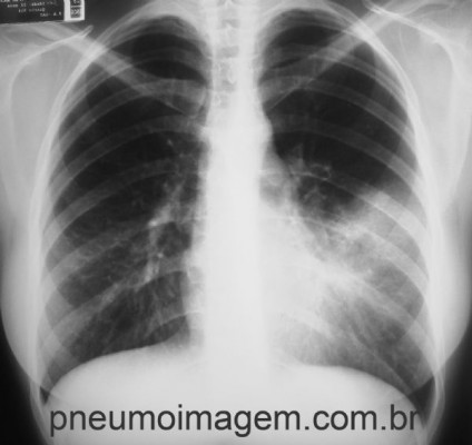 Pneumonia Atípica