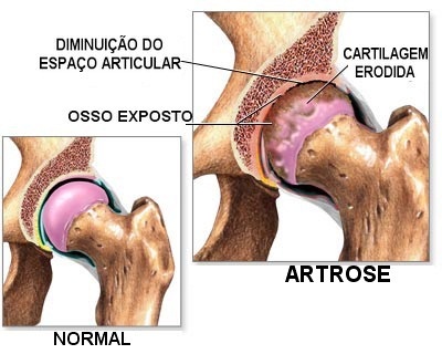 A Artrose Degenerativa