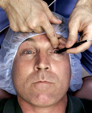 Cirurgia corretora de miopia