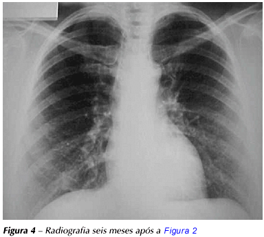 Pneumonia Eosinofílica