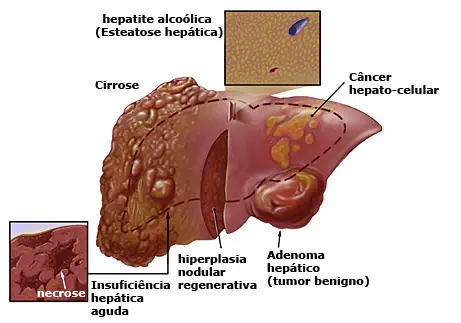 Angioma no Fígado
