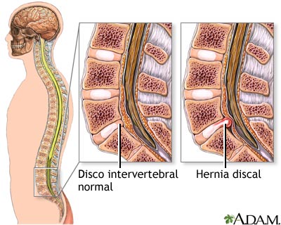 Hérnia Discal Cervical