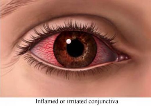 Sindrome do Olho Seco: O Que é e Como Evitá-la no Inverno