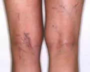 tratamento-para-evitar-vasinhos-nas-pernas-2