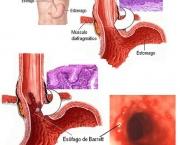 esofago-de-barrett-acidez-do-estomago-8