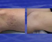 tratamento-para-evitar-vasinhos-nas-pernas-11