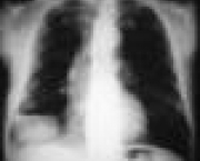 foto-abscesso-pulmonar-03