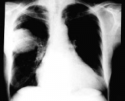 foto-abscesso-pulmonar-05