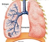 foto-abscesso-pulmonar-06