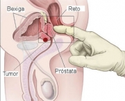 adenocarcinoma-de-prostata-o-cancer-de-prostata-5