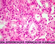 adenocarcinoma-de-prostata-o-cancer-de-prostata-7