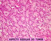 adenocarcinoma-de-prostata-o-cancer-de-prostata-8