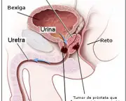 adenocarcinoma-de-prostata-o-cancer-de-prostata-1