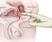 adenocarcinoma-de-prostata-o-cancer-de-prostata-4