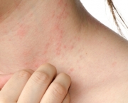 principais-tipos-alergia-pele.jpg