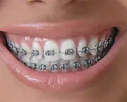 alinhamento-dentario-e-aparelhos-odontologicos-1